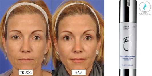 Kết quả trước và sau khi dùng sản phẩm Zo Skin Health Daily Power Defense