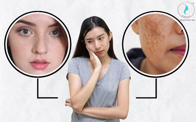 Nguyên nhân gây ra tình trạng tăng sắc tố da